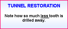 Text Box: TUNNEL RESTORATION
Note how so much less tooth is drilled away.
